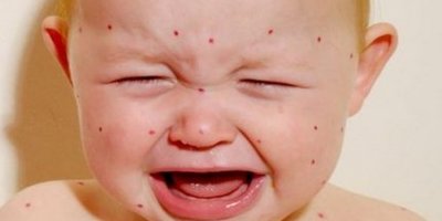 На Прикарпатті чверть дітей, що захворіли на кір, мали фальшиві довідки про вакцинацію