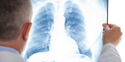 Що відбувається з легенями людини, інфікованої COVID-19 (відео)